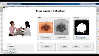 skin cancer detection [upl. by Tsenrae]