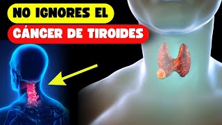 Cáncer de Tiroides 7 Señales Raras Que Pueden Pasar Desapercibidas [upl. by Adnamas]