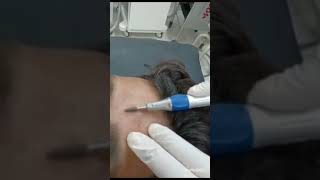 Dermabrassion for acne scar [upl. by Frankel30]