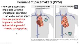 Permanent pacemakers and implantable cardiac defibrillators for exercise professionals the basics [upl. by Lowenstein940]