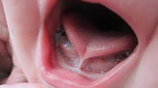 Tongue tie  Ankyloglossia 👅 [upl. by Pfeffer69]