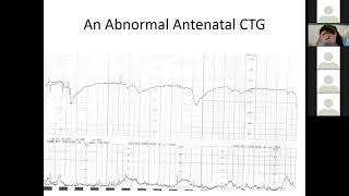 What is Cardiotocography   Gynaecology Lecture  MBBS Lecture MBBS [upl. by Cahra490]