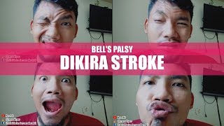 Bells Palsy  Muka Mencong Sebelah dan Cara Mengatasinya  Belpasy [upl. by Trab]