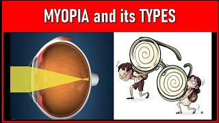 Unveiling the Secrets of Myopia Exploring Various Types and Causes [upl. by Medovich179]