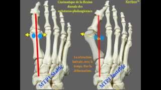 Instabilité de la première métatarsophalangienne dans lhallux valgus [upl. by Lasley]