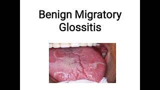 benign migratory glossitis [upl. by Karb487]