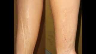 How To Get Rid Of Dark Scars On Legs [upl. by Nodanrb]