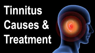 What is Tinnitus Causes amp Treatment Strategies [upl. by Leahcimnaj]