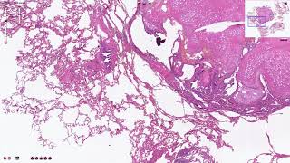 Pulmonary Hamartoma  Histopathology [upl. by Ariaet]