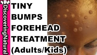 HOW TO GET RID OF TINY BUMPS ON FOREHEAD in 10 DAYS  Acne Pimple Rashes I KIDS and ADULTS [upl. by Hairaza]