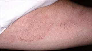 how to get rid of jock itch with baking soda [upl. by Nyret657]