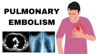 Pulmonary Embolism Pathophysiology Etiology Symptoms Diagnosis amp Treatment [upl. by Lynch]