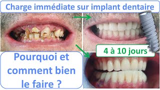 Dents fixes sur implant dentaire  Charge immédiate  Part 1 [upl. by Thom690]