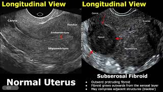 Uterus Ultrasound Normal Vs Subserosal Fibroid Images  Uterine Leiomyomas Cases  Pelvic USG Cases [upl. by Norga437]