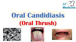 Oral Candidiasis Oral Thrush  Causes Pathophysiology Signs amp Symptoms Diagnosis Treatment [upl. by Humfrid695]