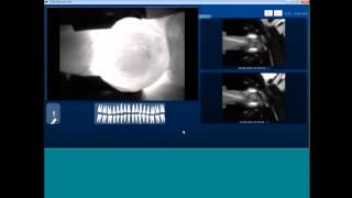 WebinarTeaser KaVo DIAGNOcam  Kariesdiagnostik ohne Röntgen [upl. by Mingche]