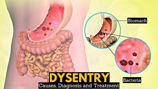 What is Dysentery Causes Signs and symptoms Diagnosis and treatment [upl. by Ahseiym704]