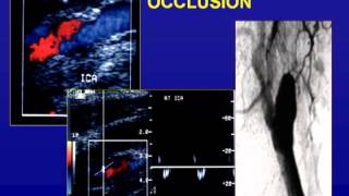 Ultrasound of the Carotid Arteries [upl. by Alie]