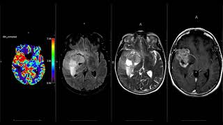 Adult Glioma Imaging  Primary IDH Wild Type Glioma [upl. by Siuluj]