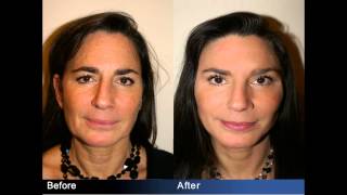 Facelift NYC Before and After Facial Plastic Surgeon Dr Sam Rizk [upl. by Beilul]