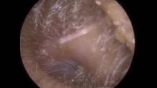 174 Matted amp Hard Ear Wax Removed from Child with Jobson Horne amp Forceps  Mr Neel Raithatha THC​ [upl. by Llewsor]