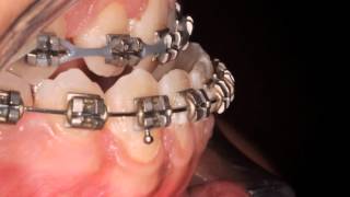 Class III  Orthodontic surgical treatments [upl. by Oirevas]