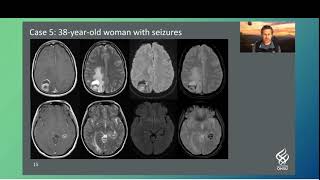 Interesting Cases Neuroradiology [upl. by Bili]