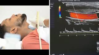 Carotid and Vertebral Arteries Doppler Ultrasound Protocols [upl. by Dahl]