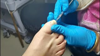 Pedicure painless nails removal Fungal nail treatment amp ingrown toenails removal [upl. by Rose920]