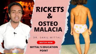 Rickets and Osteomalacia Lecture in Hindi By Dr Sahil Mittal [upl. by Ahsirek]