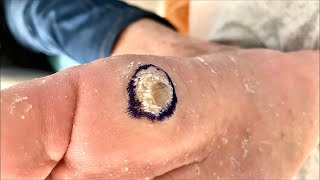 Callus removal from feetampFoot scraping dead skin 【Xiao Yan Pedicure】125 [upl. by Ahcirt]