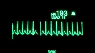 SVT with Synchronized Cardioversion [upl. by Nnaycart243]