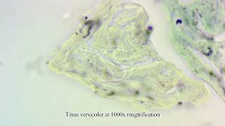 Tinea versicolor under the microscope with Gomoris Methenamine Silver GMS stain [upl. by Noyk206]