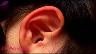 Ear Wax ReviewEndoscopic earwax removalYoung Woman has Hearing Loss due to Massive Earwax [upl. by Myron]