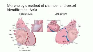 第3回小児webinar Segmental approach to congenital heart disease 佐々木 奈央 [upl. by Nairam]