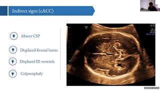 Corpus Callosum How easy diagnosis Francesco D’Antonio [upl. by Nade]