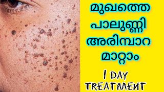 1 DAY Treatment to remove skin tag warts from face amp body Skin tag treatmentwarts remover [upl. by Mellman452]