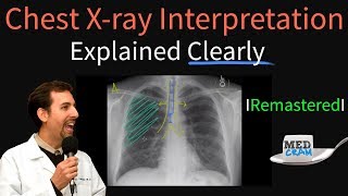 Chest X Ray Interpretation Explained Clearly  How to read a chest Xray [upl. by Anoniw954]