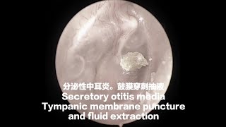 （去色版）分泌性中耳炎鼓膜穿刺抽吸鼓膜切开Tympanic membrane aspirationMyringotomy2023092705 [upl. by Vezza]