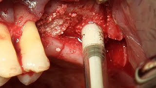 Sinus elevation  Crestal approach using Sinus Elevator amp NR Line system [upl. by Cusack]