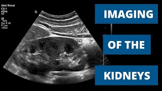 How to Image the Kidneys  When to Use Ultrasound CT and MRI [upl. by Elia66]