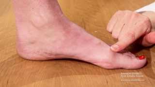 Functional Hallux Limitus  Physician Version  FDFAC  San Francisco  Dr Jenny Sanders [upl. by Erving]