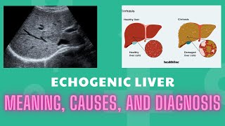 Echogenic Liver Meaning Causes And Diagnosis [upl. by Swanhilda179]