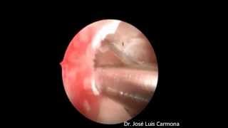 Histeroscopia estenosis cervical OCE  atrofia endometrial Dr Jose Luis Carmona Garcia [upl. by Harbird]