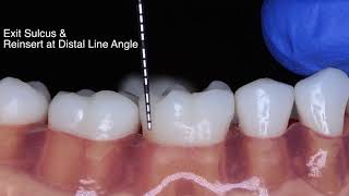 Periodontal Probe Basic Technique [upl. by Dlorrej824]