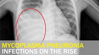 Mycoplasma pneumonia infections on the rise  Taiwan News  RTI [upl. by Muhammad]