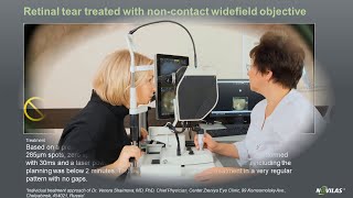 Laser retinopexy Noncontact navigated laser treatment of a retinal tear with Navilas® 577s [upl. by Mayworm]