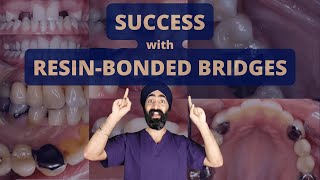 Success with Resin Bonded Bridges aka Adhesive Bridges or formerly Maryland  PDP132 [upl. by Gomez]