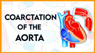 Coarctation of the aortaCoAtypes etiologypathophysiologyclinical featurediagnosis amp treatment [upl. by Ardnoet]