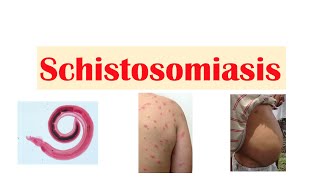 Schistosomiasis  Bilharziasis  Causes Symptoms and Treatment [upl. by Xxam]